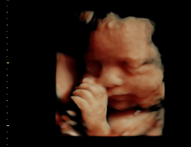 3D ultrasound image at 31 weeks